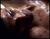 Smallpox sufferer